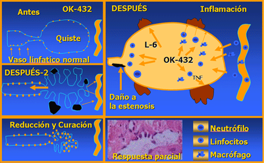 Mecanismo de Acción de OK-432 Picibanil